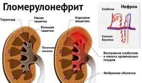 Влияние плохих привычек и низкое давление