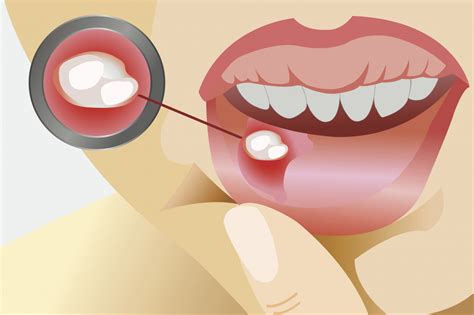 Как лечить белые болячки в полости рта