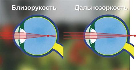 Проблемы с близорукостью