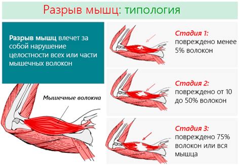 Разрыв сухожилий и мышц