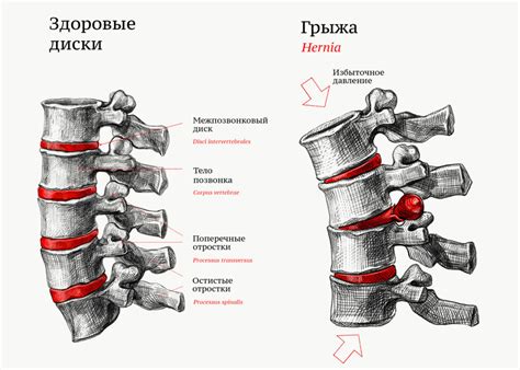 Факторы, способствующие развитию грыжи позвоночника