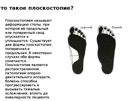 Что такое плоскостопие и почему оно может вызывать боль в ногах